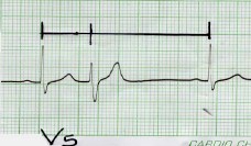 arritmia_ventricular arritmia_ventricular