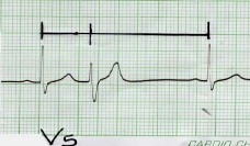 arritmia_ventricular