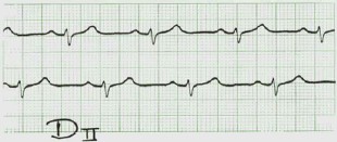 arritmia_ventricular2 arritmia_ventricular2