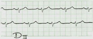 arritmia_ventricular2