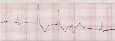 dupla_extrasistoles_ventriculares dupla_extrasistoles_ventriculares