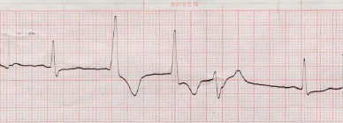 dupla_extrasistoles_ventriculares