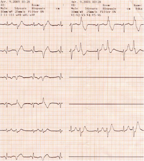 extrasistoles_ventriculares_bigeminadas2