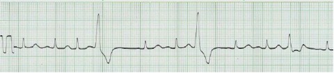 latido_ectopico_supraventricular latido_ectopico_supraventricular