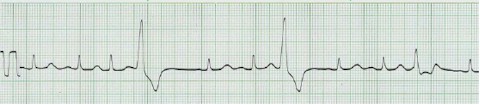 latido_ectopico_supraventricular