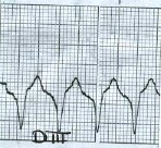 taquicardia_QRS_ancho3