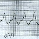 taquicardia_QRS_ancho5