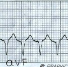 taquicardia_QRS_ancho6