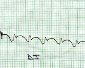 taquicardia_ventricular_sostenida