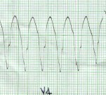 taquicardia_ventricular_sostenida10