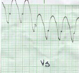 taquicardia_ventricular_sostenida11