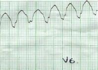 taquicardia_ventricular_sostenida12