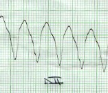 taquicardia_ventricular_sostenida2