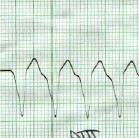 taquicardia_ventricular_sostenida3