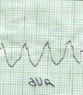 taquicardia_ventricular_sostenida4