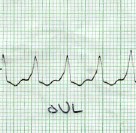 taquicardia_ventricular_sostenida5