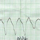 taquicardia_ventricular_sostenida6