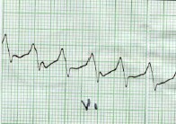 taquicardia_ventricular_sostenida7