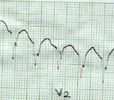 taquicardia_ventricular_sostenida8