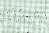 taquicardia_ventricular_sostenida9