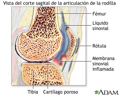 artritis_reumatoid_articulacion_rodilla2