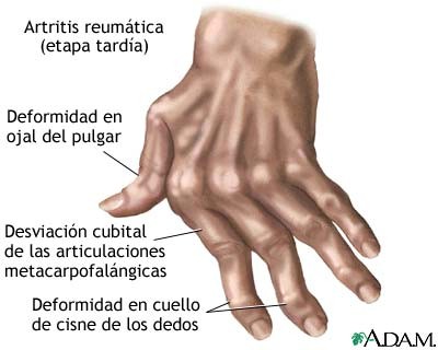 artritis_reumatoide_artritis_reumatica