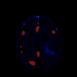 astrocitoma_5