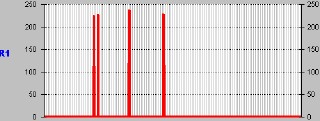 astrocitoma_canalR1 astrocitoma_canalR1
