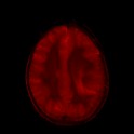 astrocitoma_imagen2