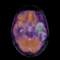 astrocitoma_metastatico2 astrocitoma_metastatico2