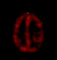 astrocitoma_resultados_imagenes12