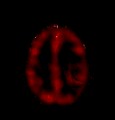 astrocitoma_resultados_imagenes12