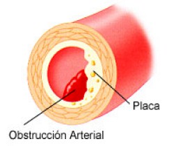 aterosclerosis aterosclerosis
