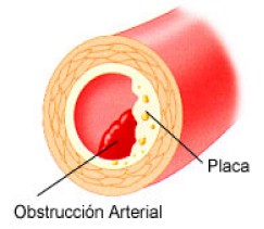 aterosclerosis