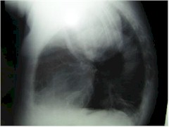 bocio_intratoracico_Rx2 bocio_intratoracico_Rx2