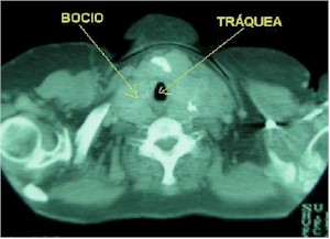 bocio_intratoracico_TAC1 bocio_intratoracico_TAC1