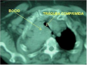 bocio_intratoracico_TAC2 bocio_intratoracico_TAC2