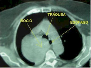 bocio_intratoracico_TAC3 bocio_intratoracico_TAC3