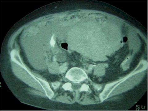 carcinomatosis_calibre_ureter carcinomatosis_calibre_ureter
