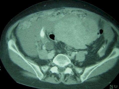 carcinomatosis_cancer_ovario2 carcinomatosis_cancer_ovario2