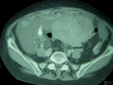 carcinomatosis_cancer_ovario2