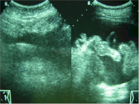 carcinomatosis_ecografia carcinomatosis_ecografia