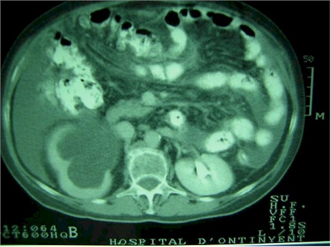 carcinomatosis_hidronefrosis carcinomatosis_hidronefrosis