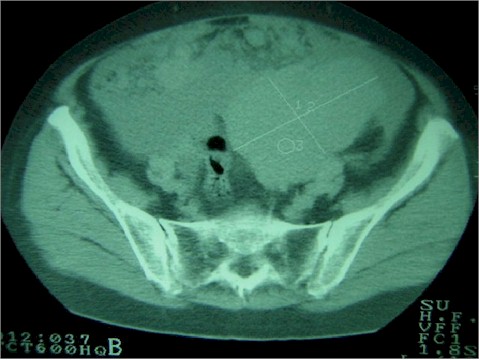 carcinomatosis_vascularizacion