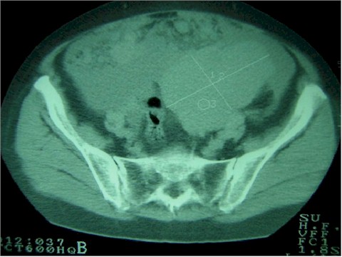 carcinomatosis_vascularizacion carcinomatosis_vascularizacion