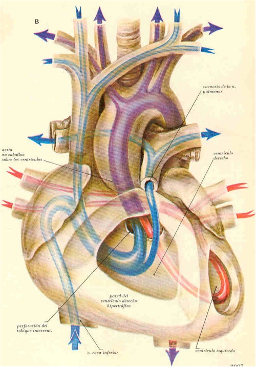 cardiopatia_corazon cardiopatia_corazon