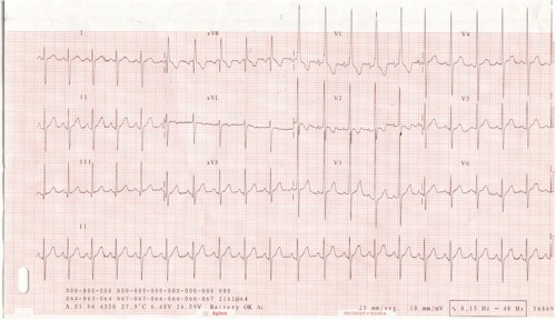 cardiopatia_taquicardia_sinusal