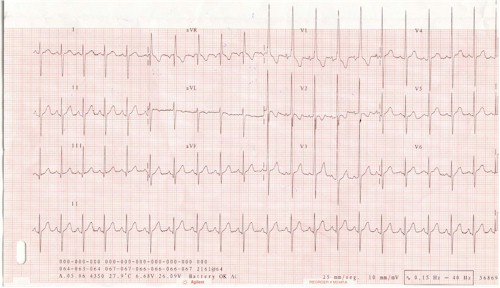 cardiopatia_taquicardia_sinusal cardiopatia_taquicardia_sinusal