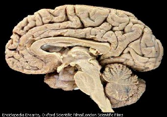 cefalea_horton_cerebro cefalea_horton_cerebro