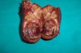cistoadenoma_hepatico_colecistectomia2